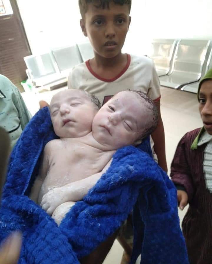حالة نادرة في البلاد... ولادة طفل سيامي برأسين في محافظة الحديدة( صورة)