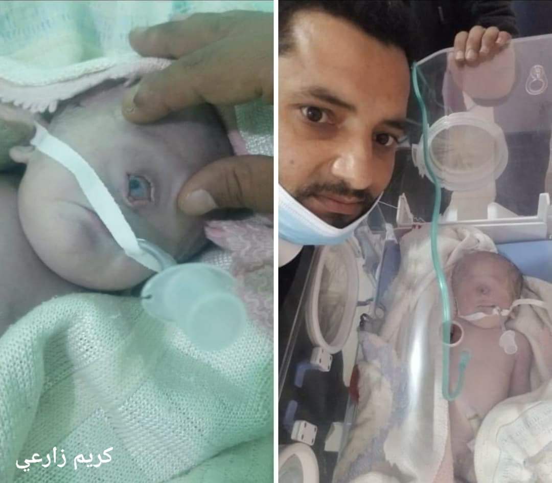 لاول مرة تحدث في اليمن .. ولادة طفل بعين واحدة وتجويف عيني واحد وعصب بصري واحد(صورة)